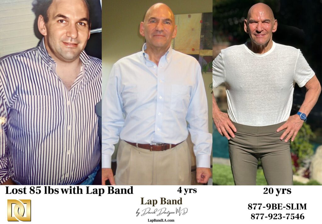 Lap-Band patient before and after long-term weight loss results