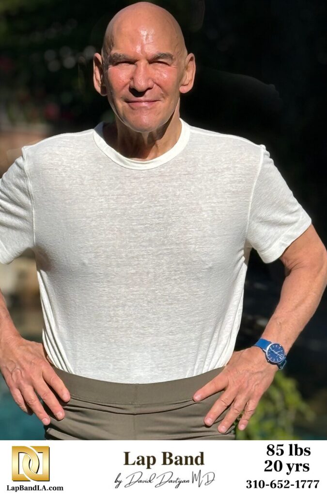 Losing 85 lbs with the lap band and keeping it off for 20 years: success story of Jeff Wiess, a professor at UCLA