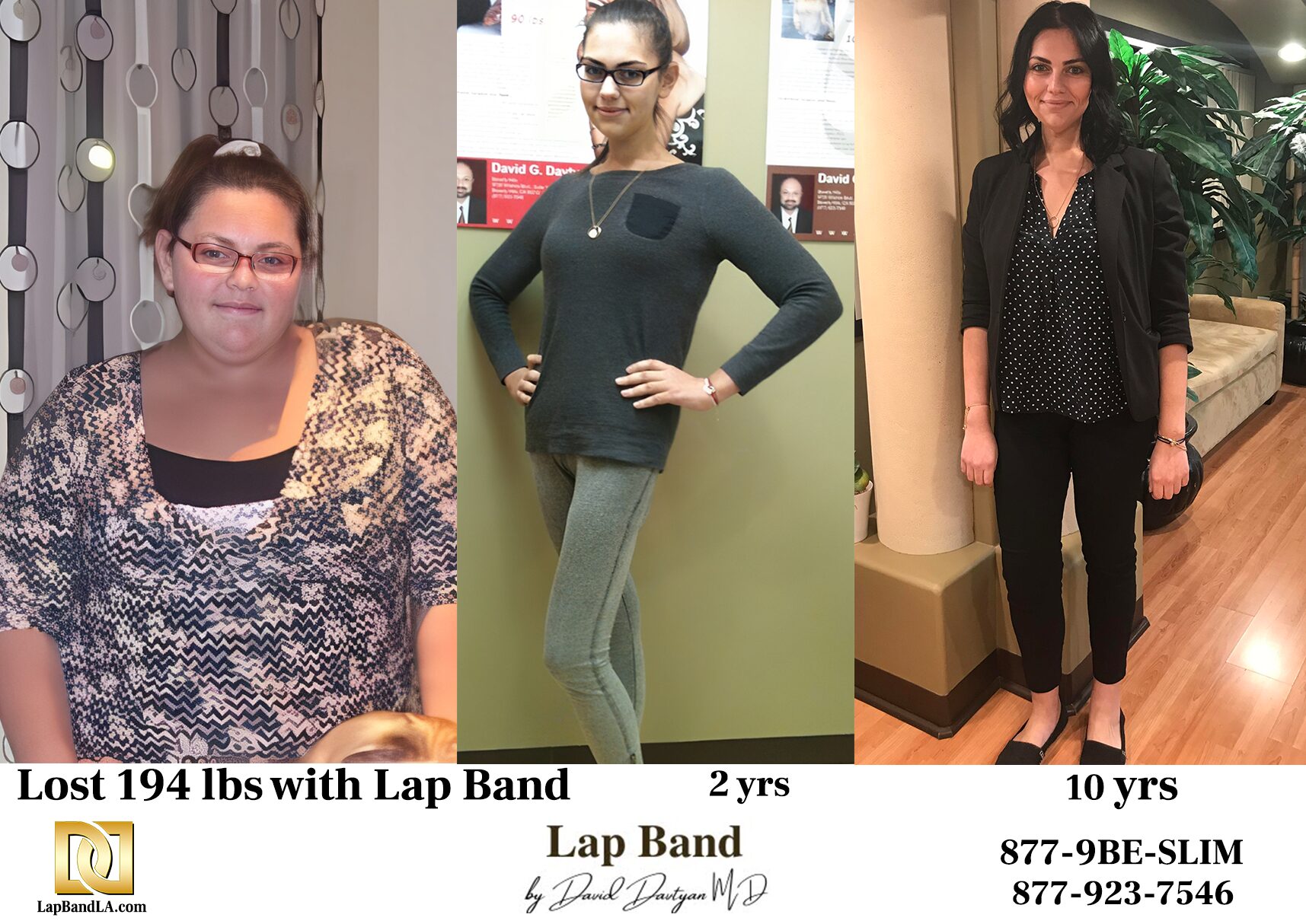 Female patient before and after lap band surgery showing 194 pound weight loss maintained over 10 years