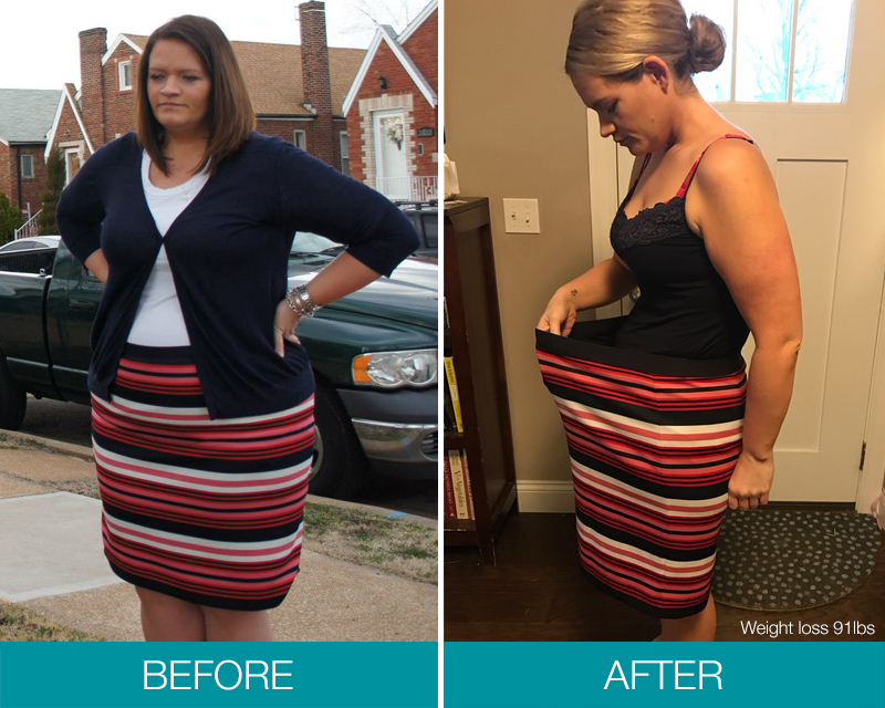 Weight Loss Surgery Before and After Gastric Balloon