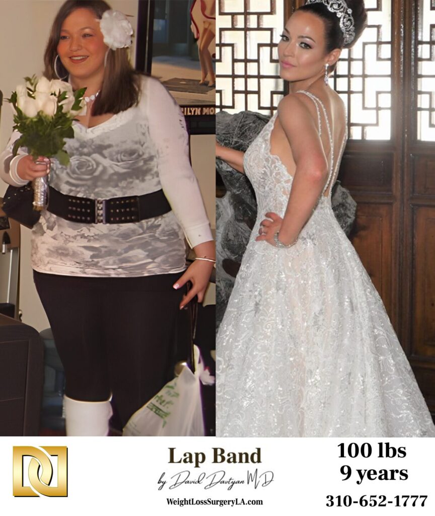 Female patient before and after Lap Band weight loss surgery at Lap Band LA