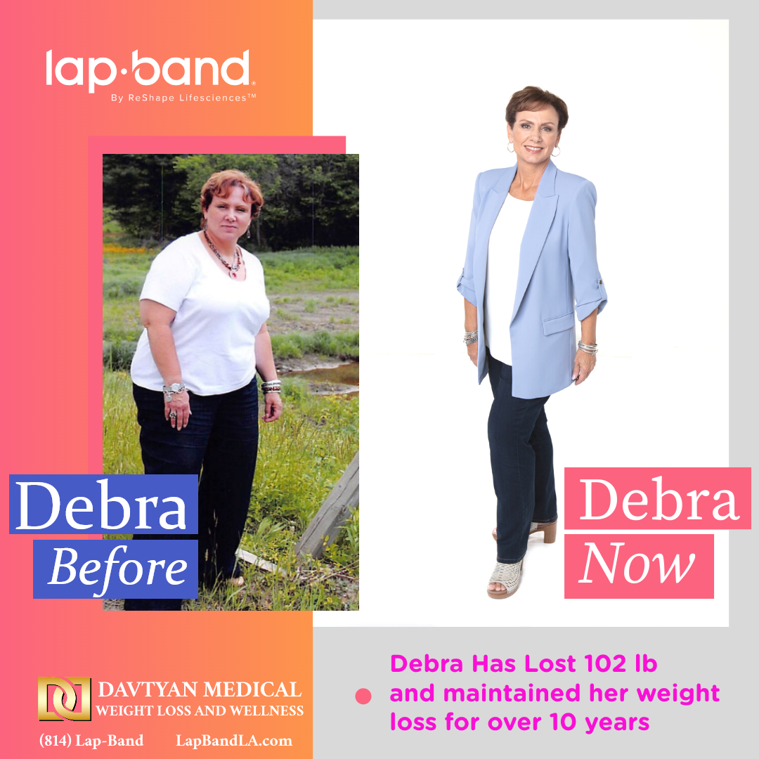 Lap band before and after 102 pound weight loss results Female patient before and after lap band surgery showing 102 pound weight loss maintained for over 10 years