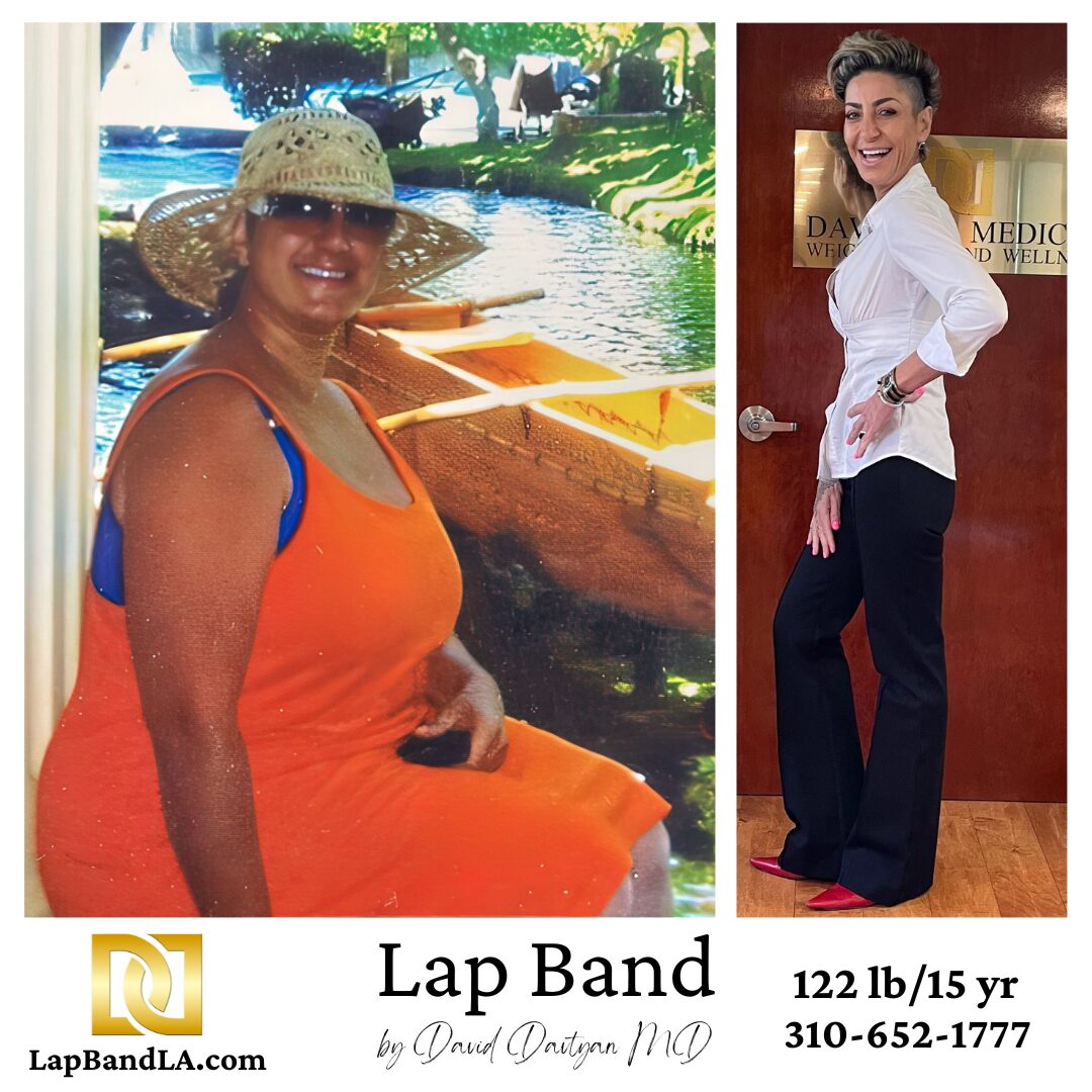 Lap-Band before and after patient weight loss journey