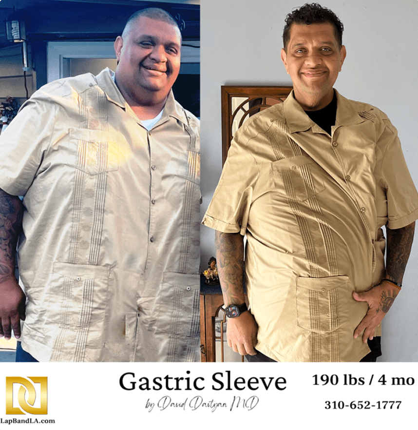 Gastric sleeve before and after weight loss results in Los Angeles Male patient before and after gastric sleeve bariatric surgery at Lap Band LA