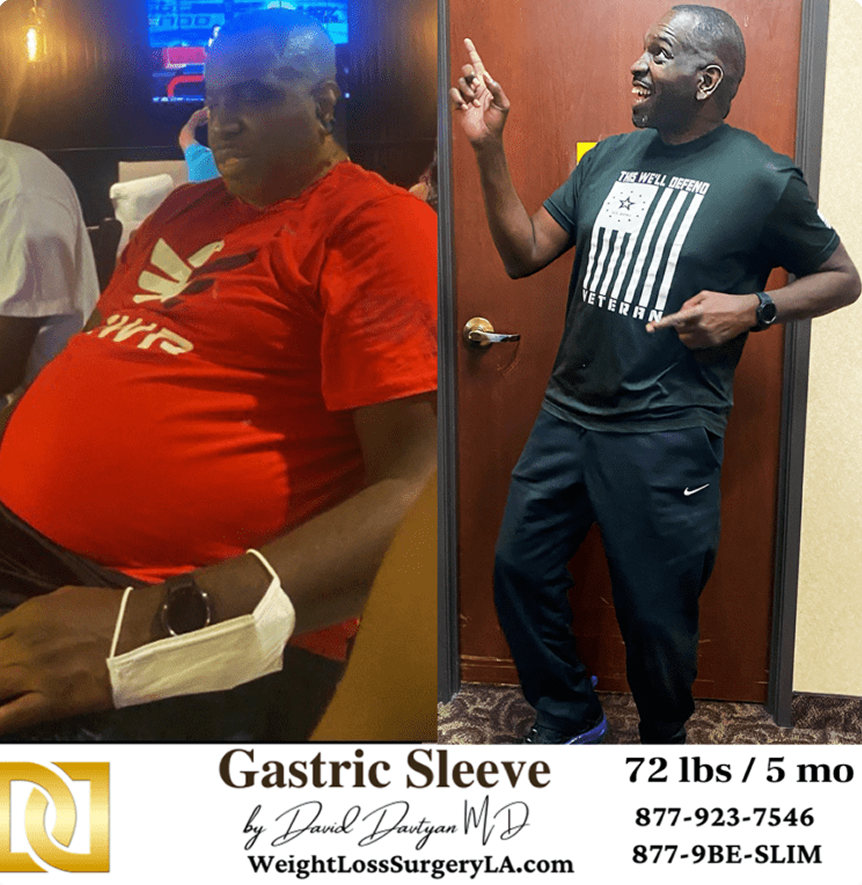 Male patient before and after gastric sleeve weight loss surgery at Lap Band LA