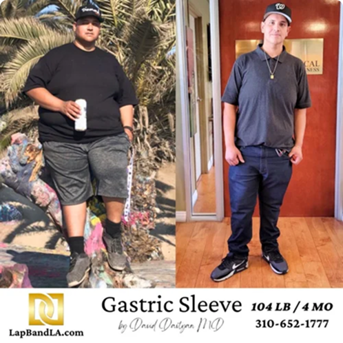 Male patient before and after gastric sleeve surgery showing 104 pound weight loss in four months