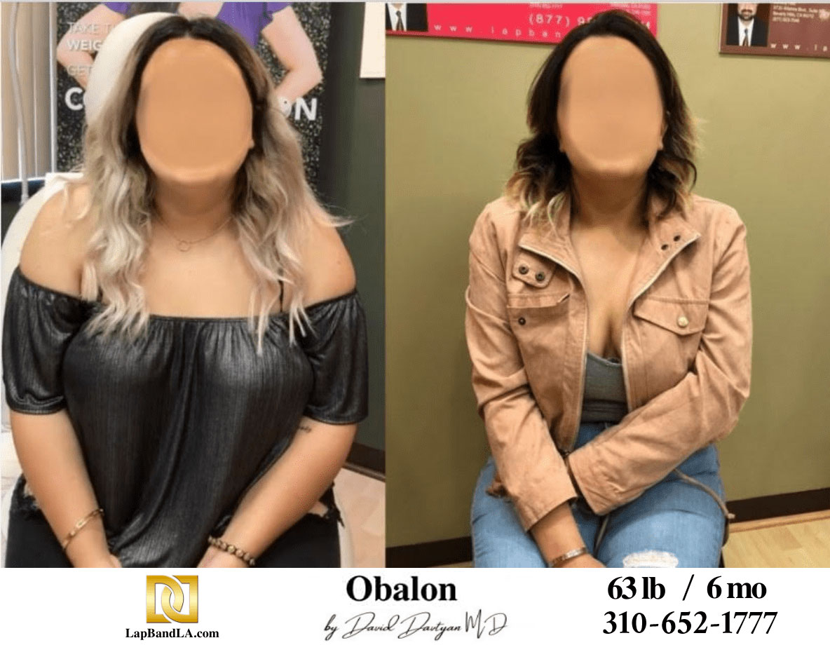 Obalon gastric balloon before and after recovery results after 6 months