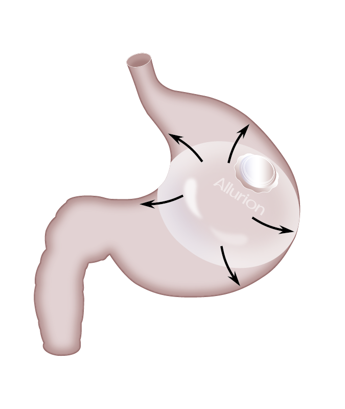 Allurion Balloon Illustration watermark Allurion Balloon Illustration watermark